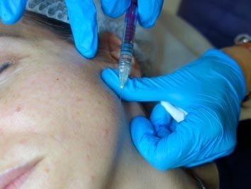 Mesoterapia facial en Santa Pola