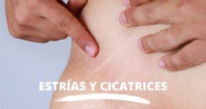 Estrias - Clinica medicina estética Santa Pola